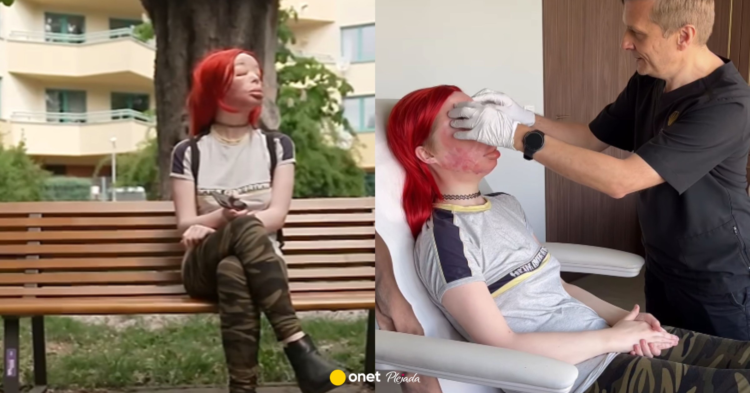 Elva po samodzielnym wstrzykiwaniu silikonu nie widzi na jedno oko. Lekarz przekazał nowe informacje